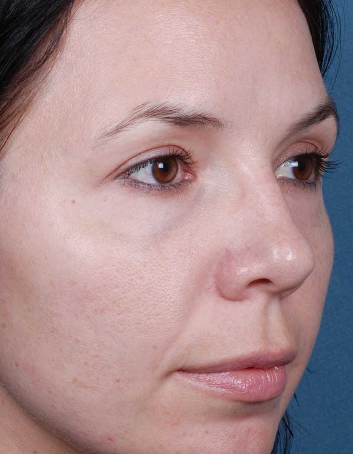 Chemical Peel After
